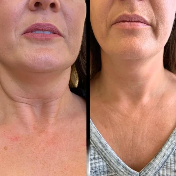 Best Plastic Surgeon in Dubai Offering Expert Profhilo Plans