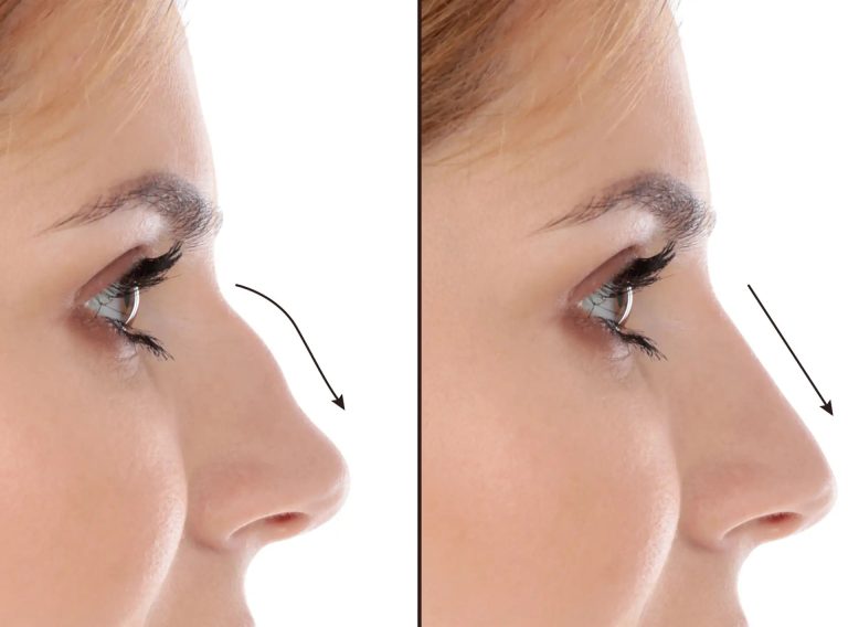 Nose Surgery in Dubai: Precision Care for Functional and Aesthetic Needs
