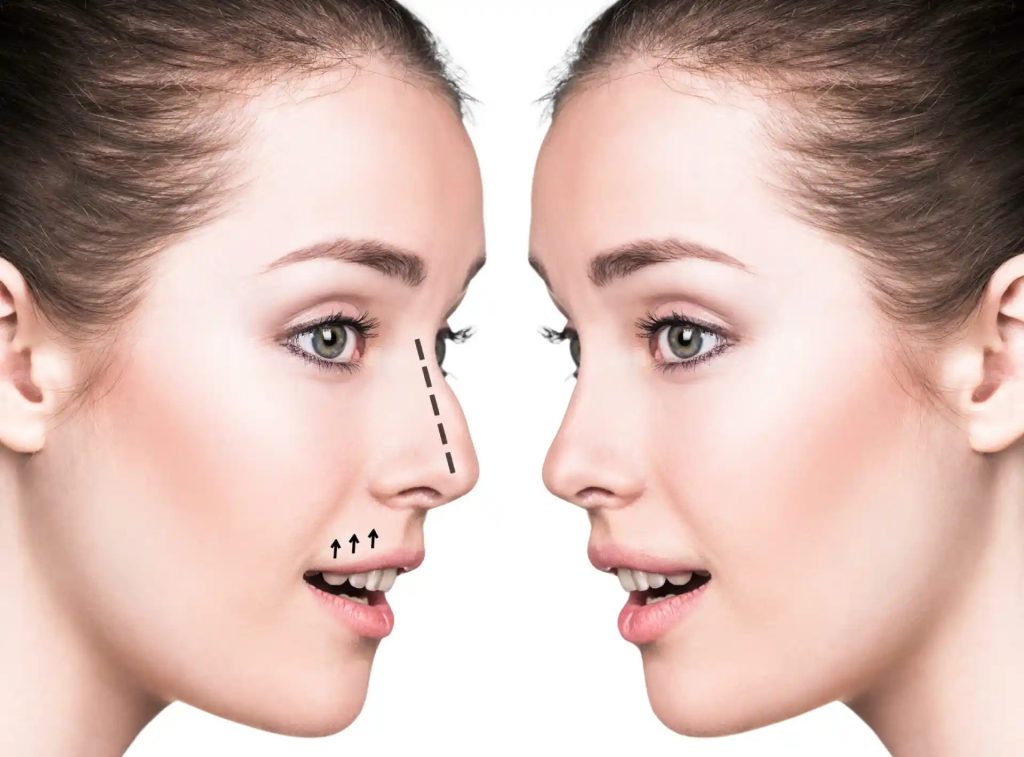 Best Doctors in Dubai: Measured Rhinoplasty Results