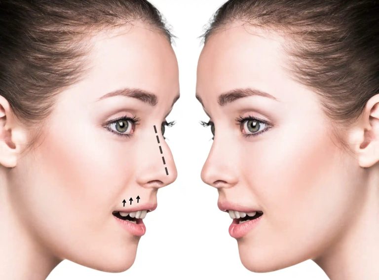 Best Doctors in Dubai: Measured Rhinoplasty Results