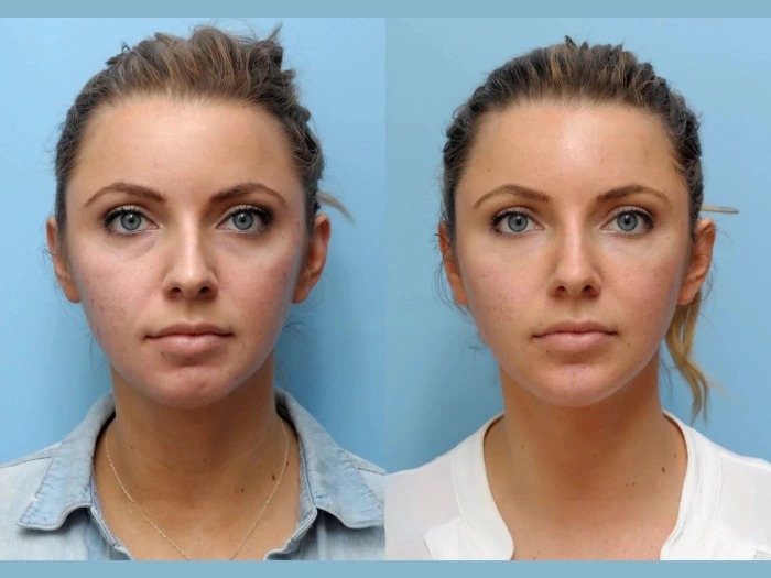 Best Doctors in Dubai Offer Advanced Thread Lift Solutions For Youthful Faces