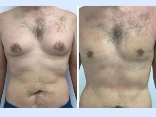 The Role of Patient Education in Gynecomastia in Dubai Treatment Success