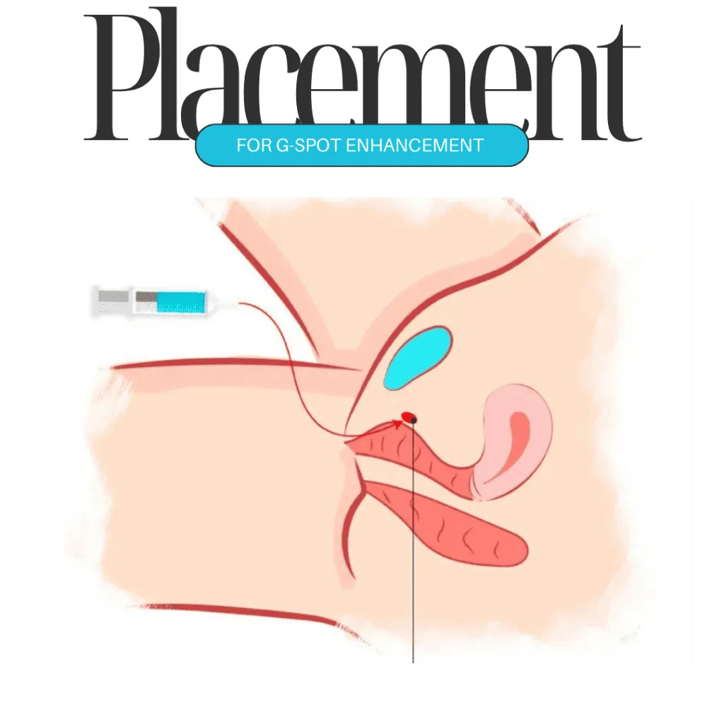 G-spot Enhancement in Dubai: Benefits, Procedure, and Expected Results