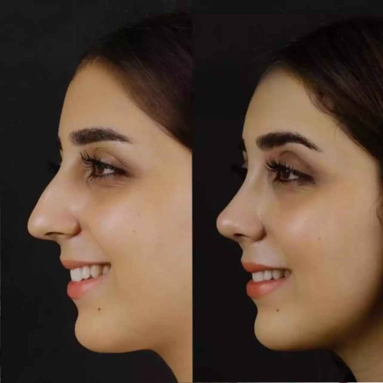 Septoplasty Excellence Guided by Best Doctors in Dubai