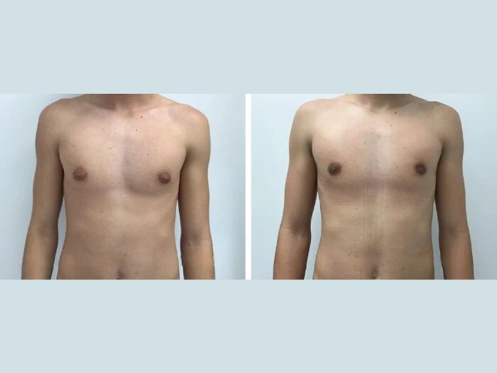 Gynecomastia Surgery in Dubai: Trusted Expertise for Men