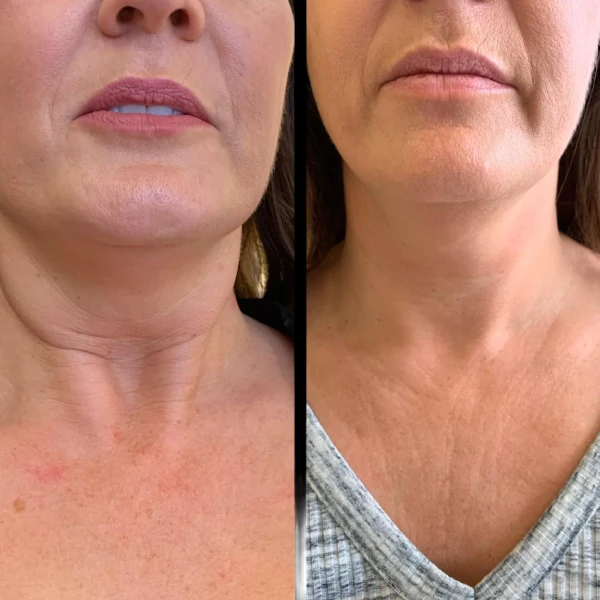 Best Plastic Surgeons in Dubai Combining Surgery and Profhilo