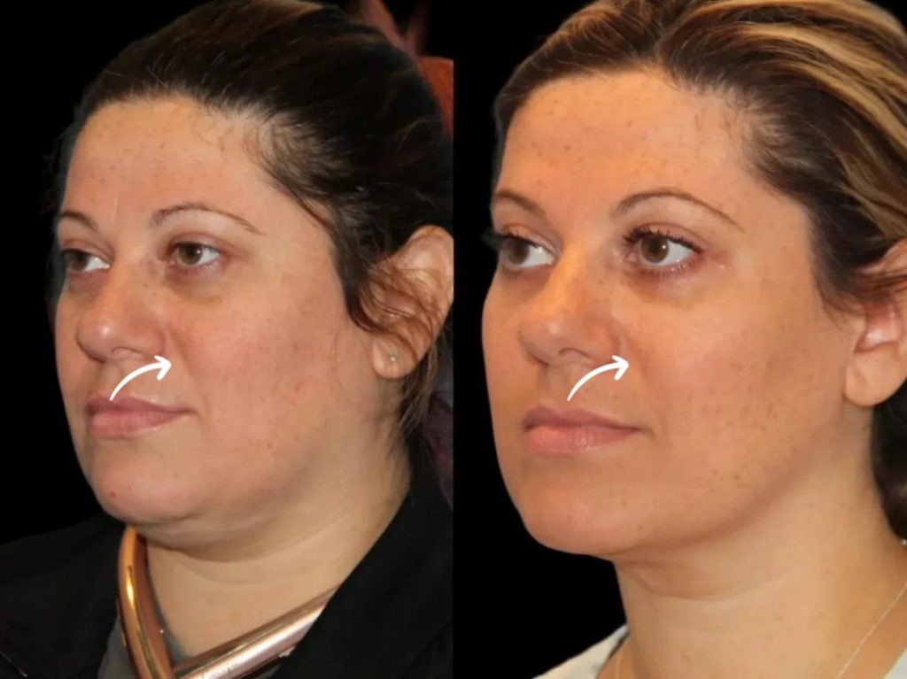 Best Plastic Surgeon in Dubai for Sculptra for Aging Face
