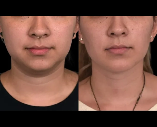 Double chin removal in Dubai 2026 guide