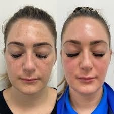 Safety, Side Effects, and Recovery Tips for Cosmelan Pigmentation Treatment in Altrincham