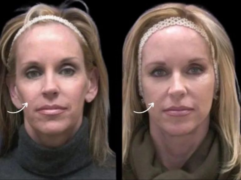 Sculptra for First Signs of Aging by Best Plastic Surgeon in DubaiI