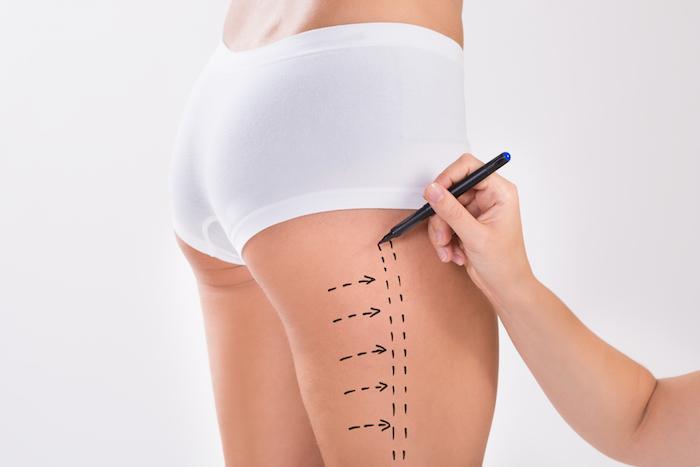 Smooth and Speedy Recovery After Liposuction Surgery in Dubai