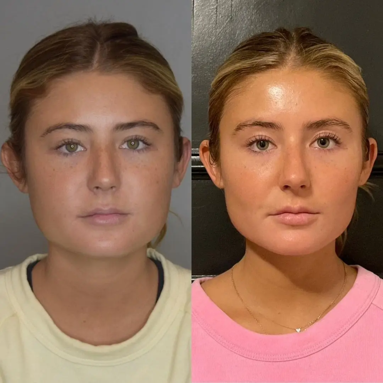 My Personal Experience with Buccal fat removal Surgery in Dubai